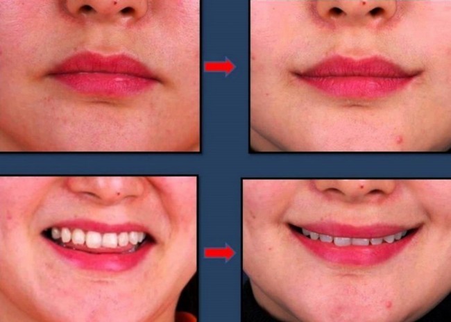 Og’iz burchaklarini ko’tarish