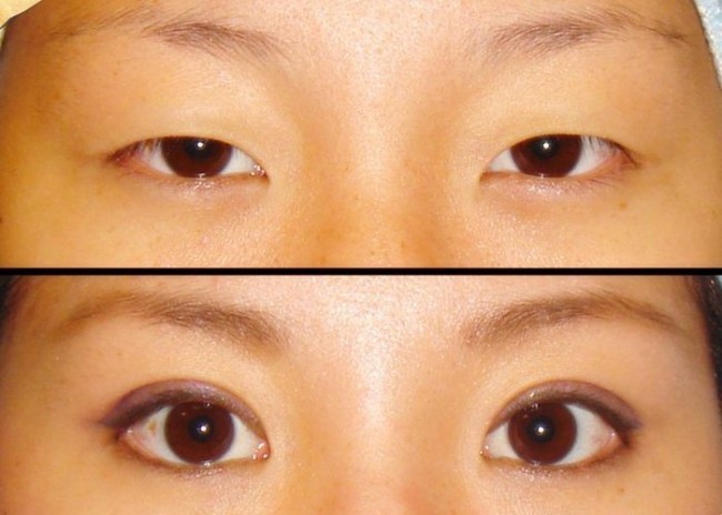 Qovoqlarni yo’qotish