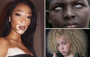 Hayratga sazovor genetik anomaliya namunalari 